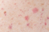 Chigger Bite: Pictures, Treatments and Prevention